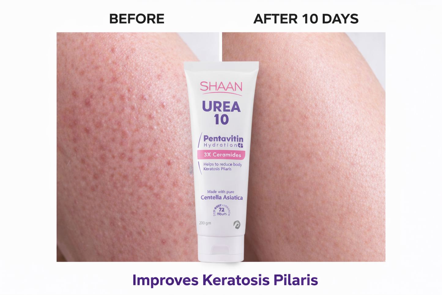 Shaan Urea 10% Body Moisturizer 200 Gm