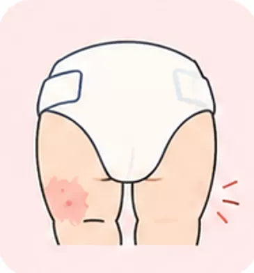 Diaper Rash