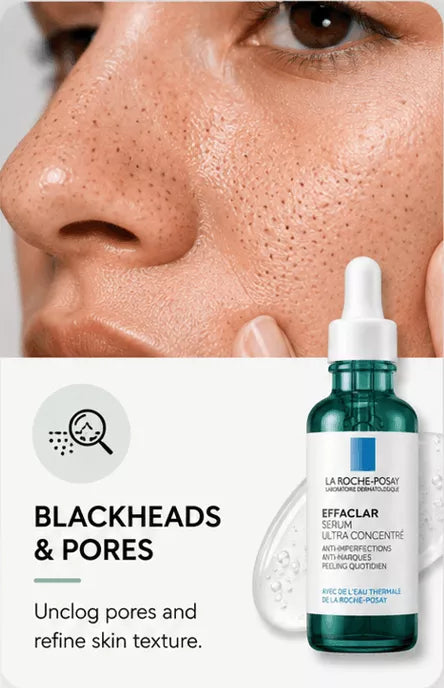 Blackheads & Pores